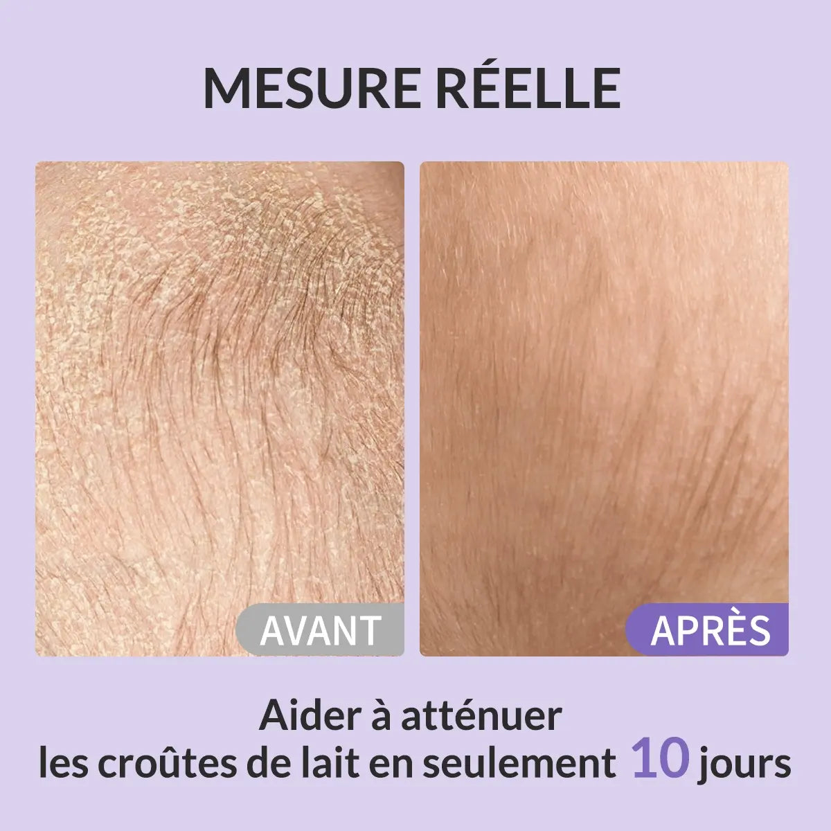 Coffret Anti-Croûtes de Lait Pour Bébé