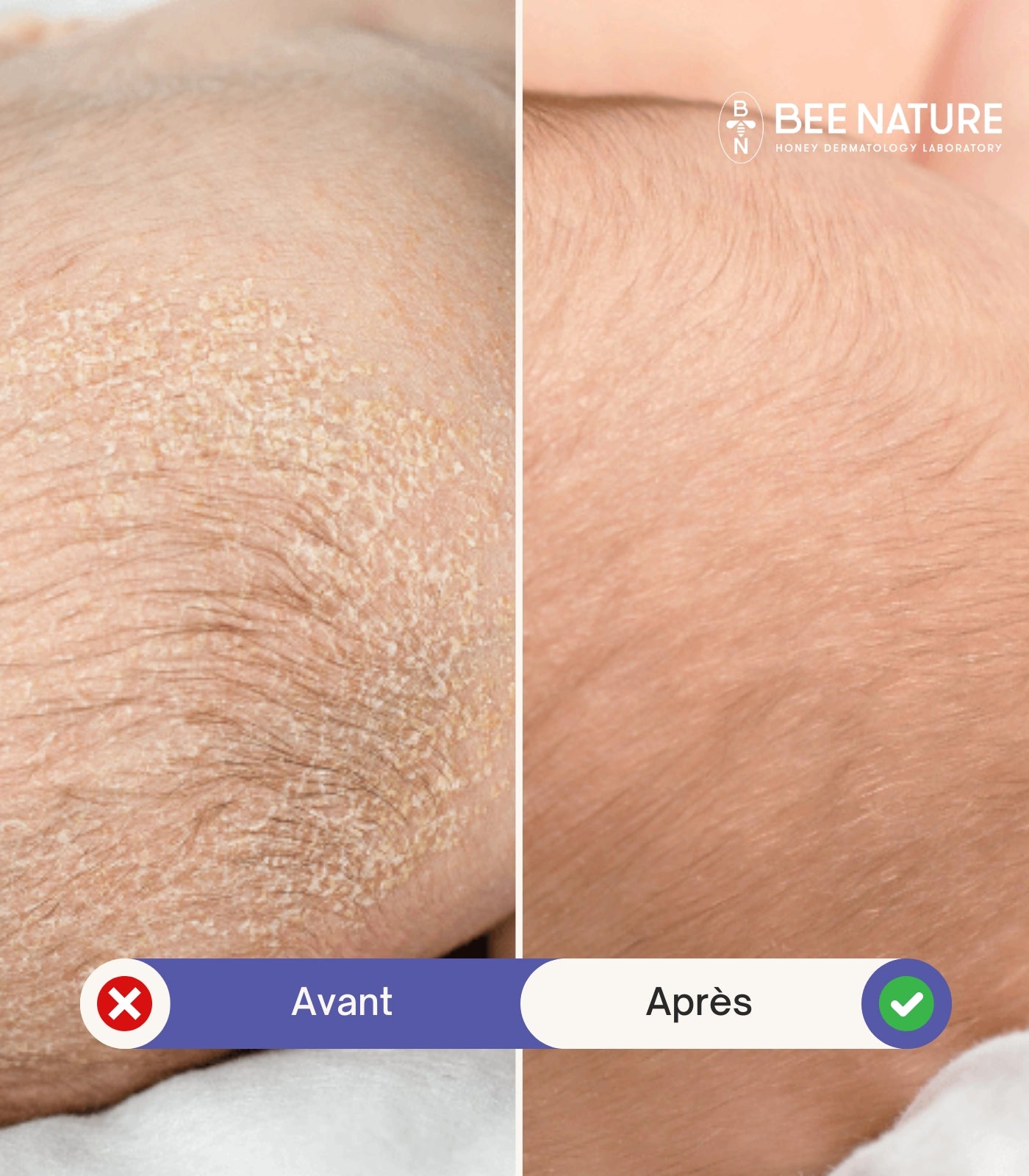 Coffret Anti-Croûtes de Lait Pour Bébé