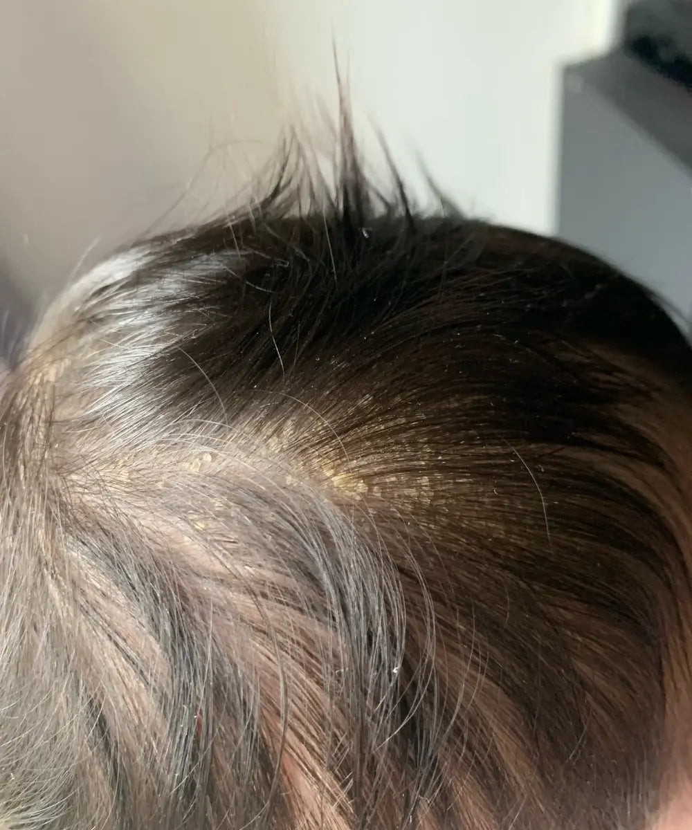 Guide 2026 – Croûtes De Lait Chez Les Nourrissons