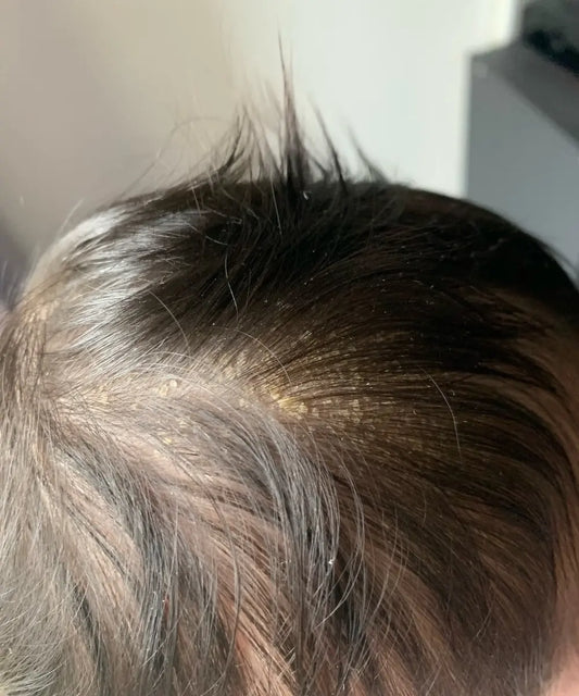 Guide 2026 – Croûtes De Lait Chez Les Nourrissons