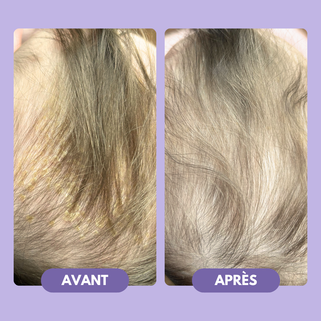 Anti-Cradle Cap Shampoo - Babyzz 