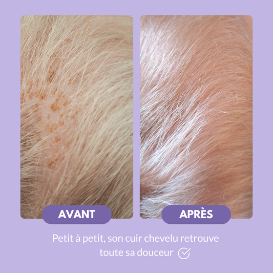 Shampoing Anti-Croûtes de Lait - Pour bébés- Babyzz