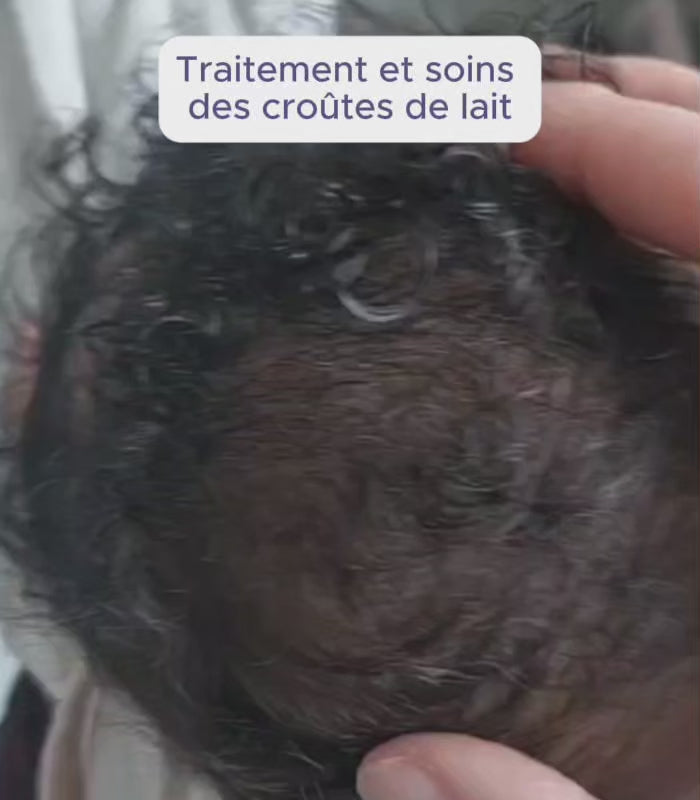 Anti-Cradle Cap Shampoo - Babyzz 